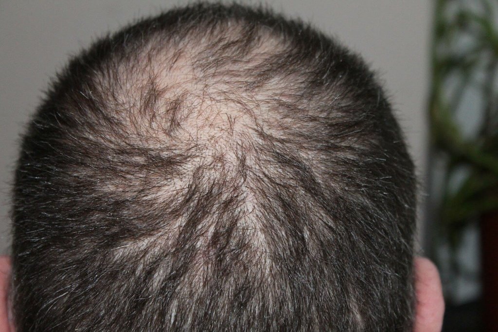 Hairloss