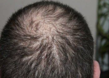 Hairloss