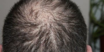 Hairloss