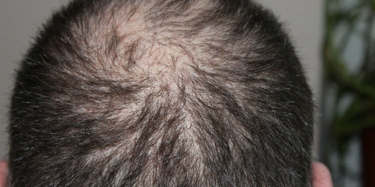 Hairloss