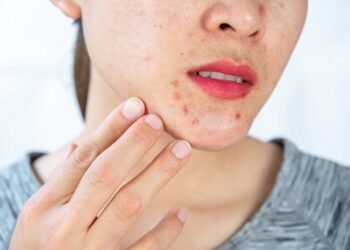 CBD Vape Pen For Rosacea