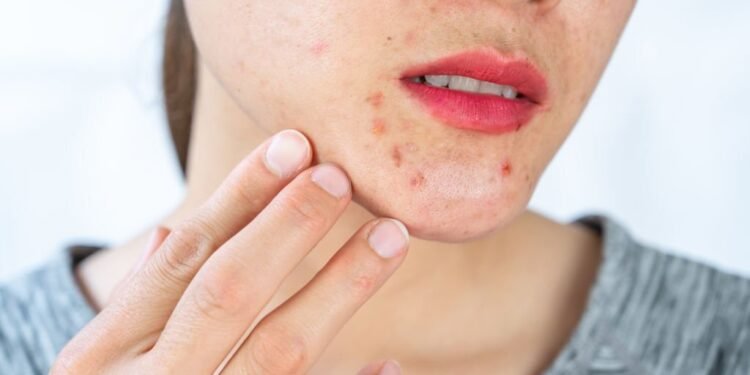 CBD Vape Pen For Rosacea