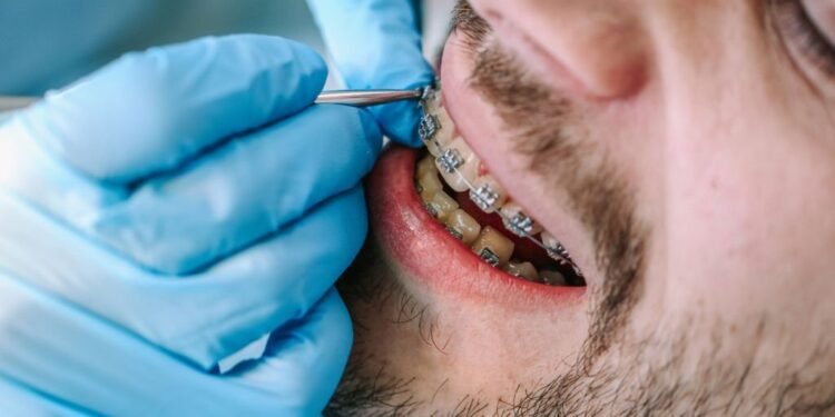 What Is Early Interceptive Orthodontic Treatment